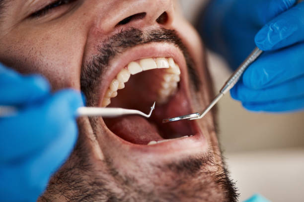 Best Emergency Wisdom Tooth Extraction in Spearville, KS