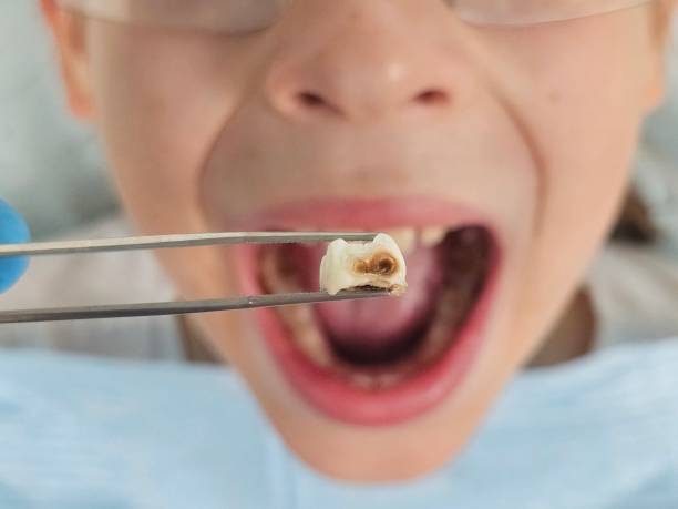 Best Dental Abscess Treatment in Spearville, KS