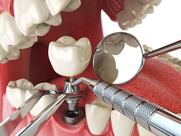 Best Lost Filling or Crown Replacement in Spearville, KS